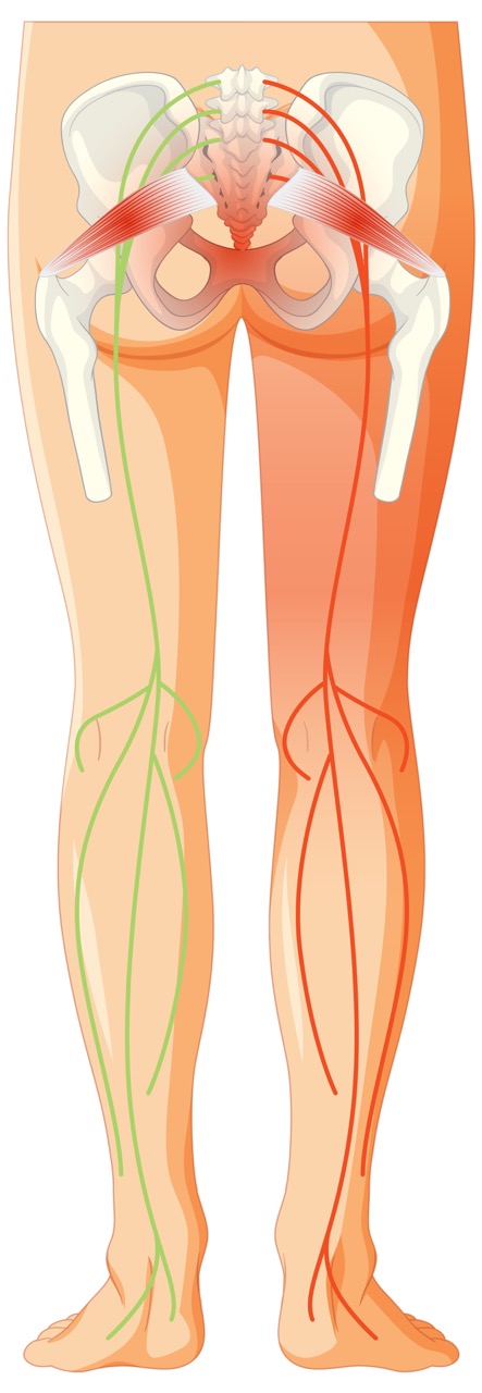 Physiotherapy treatment of sciatica