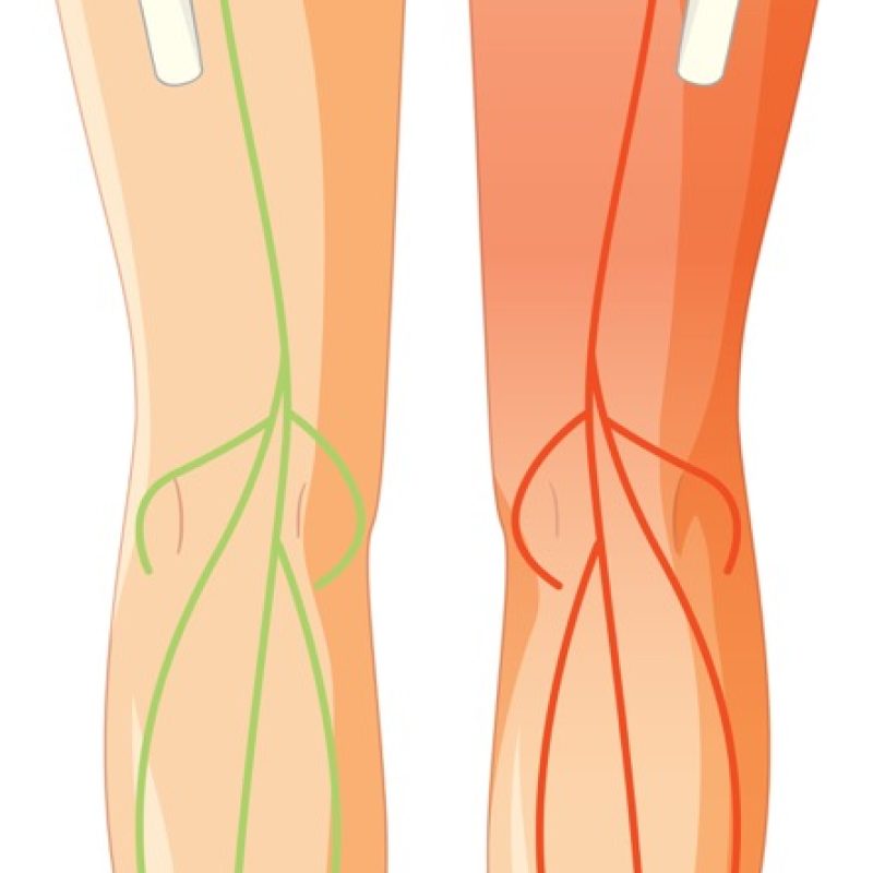 Physiotherapy treatment of sciatica